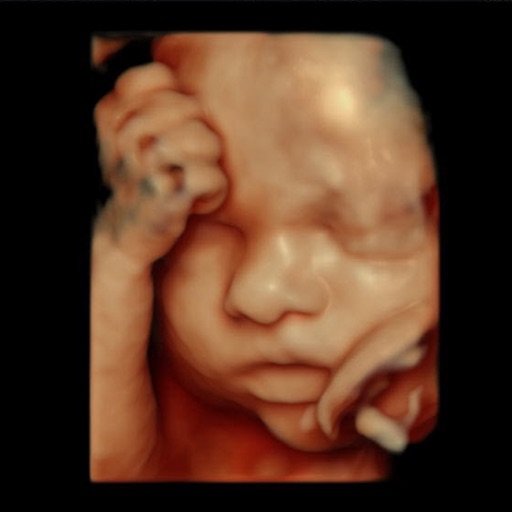 Ultrasound Image